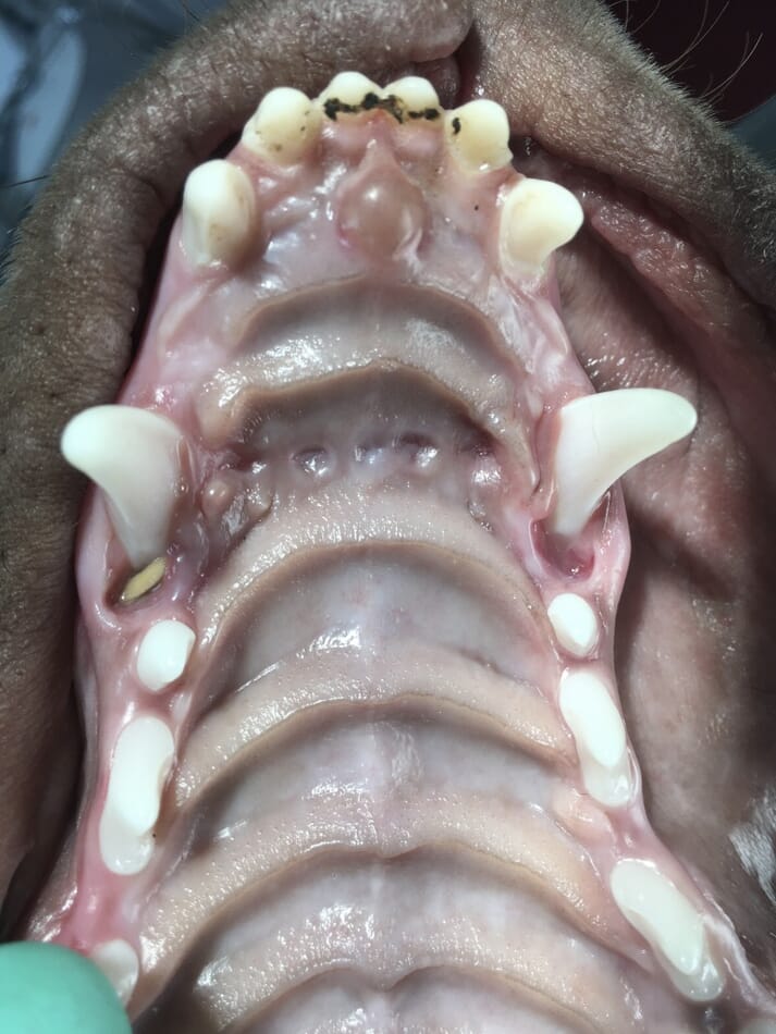FIGURE (5) Palatal view of impingement defects caused by the opposing mandibular canines and incisor teeth. It is important to not underestimate the role of the incisors in malocclusion