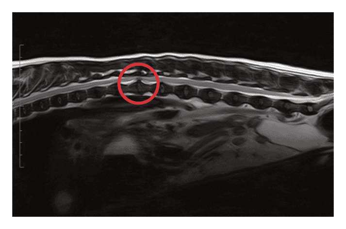 FIGURE (1) MRI image showing a T13-L1 disc extrusion