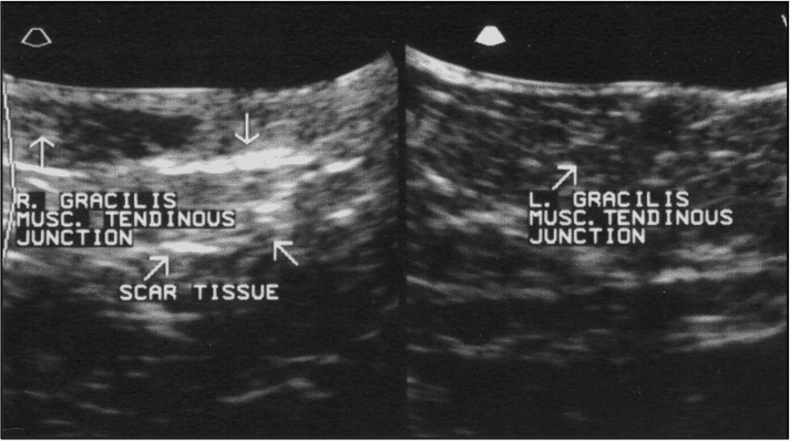 FIGURE (3) Ultrasound is another useful diagnostic tool. Pictured here are images from cases with gracilis injury. Note the hypoechoic regions on the left image typical of acute injury and the hyperechoic regions of scar tissue on the right image
