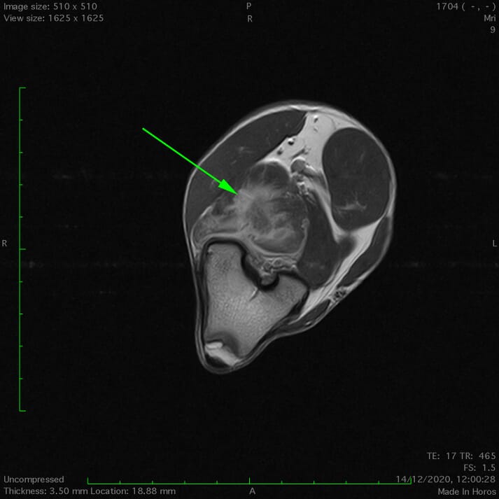 FIGURE (4) MRI is the gold standard modality for assessing soft tissue injuries in humans and is becoming more commonplace in animals. This image (T1 weighted post-contrast) shows injury within the lateral head of the gastrocnemius in a Border Collie
