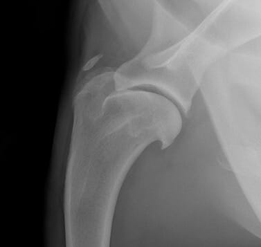 FIGURE (5) Radiography and CT can reveal mineralisation within the tendon, as pictured here within the tendon of insertion of the biceps muscle