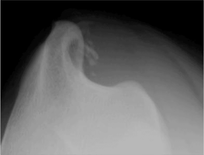FIGURE (6) In this “skyline” projection down the bicipital groove, you can see that mineralisation in this case is more likely to be clinically significant due to compression of the adjacent biceps tendon of insertion