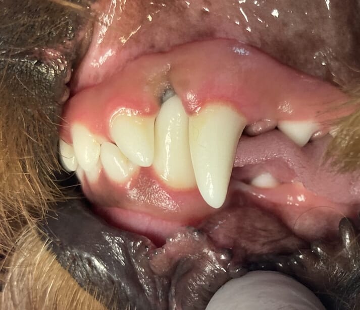 FIGURE (7) A combination approach can often be useful, such as a combination of a third incisor extraction, to create space to tip an impinging mandibular canine tooth labially by means of a composite inclined plane, and temporary crown extension on the left mandibular canine tooth here