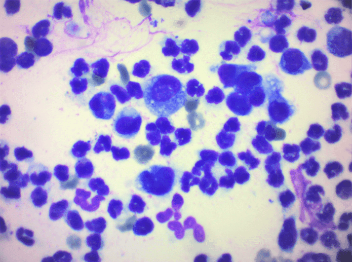FIGURE (2) Neutrophils and vacuolated macrophages on cytology confirm the diagnosis of sterile pyogranulomatous/granulomatous dermatitis