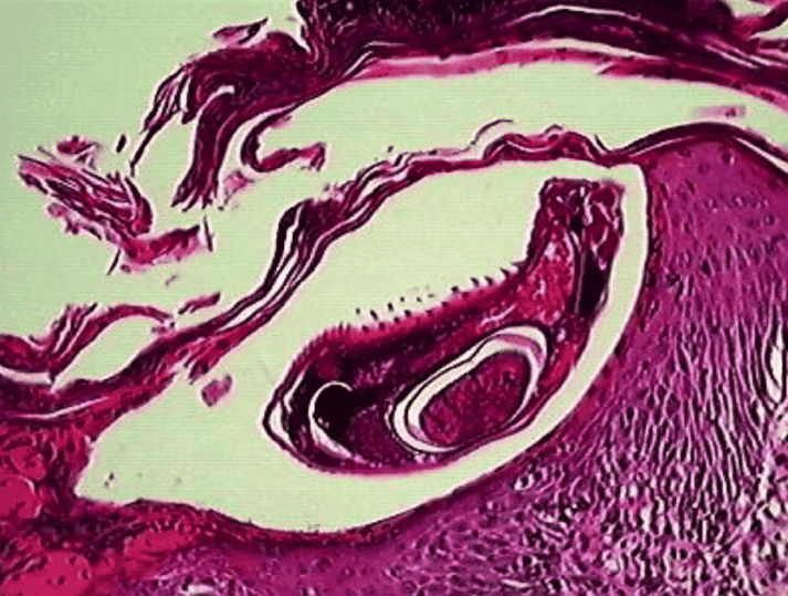 FIGURE (4) Rarely, Sarcoptes scabiei mites are found. The dorsal spines of the mites may be seen in skin biopsies (image courtesy of David Shearer)