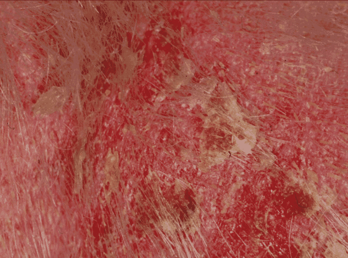 FIGURE 3 Severe crusting and pustular lesions of recurrent superficial pyoderma in a two-year-old West Highland White female dog. The underlying cause was generalised demodicosis, suggested by the extensive erythema and confirmed by tape stripping. Previous treatment consisted of glucocorticoids for suspected atopy, which had not been confirmed. Following resolution of the demodicosis, there was no recurrence of the pyoderma