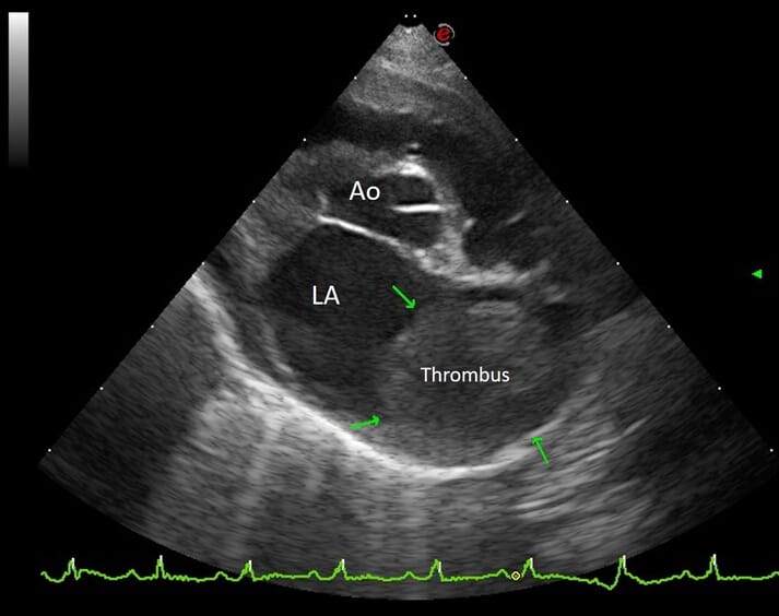 Echocardiographic image of the thrombus