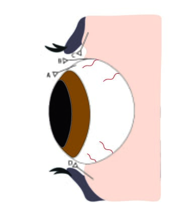 FIGURE (2) Eye injections can be made in several locations in cattle, shown here: A – bulbar subconjunctival, B – palpebral subconjunctival injection (junction of sclera and eyelid), C + D – intramuscular injection into upper or lower eyelids, a site commonly used by farmers