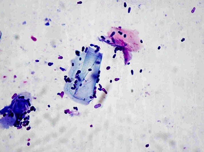 FIGURE 4 Numerous Malassezia organisms (at X1,000 magnification) from an adhesive tape preparation stained with Diff-Quik