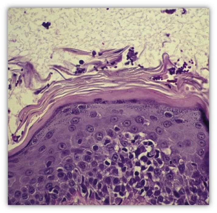 FIGURE 5 Malassezia organisms in the deeper layers of the stratum corneum