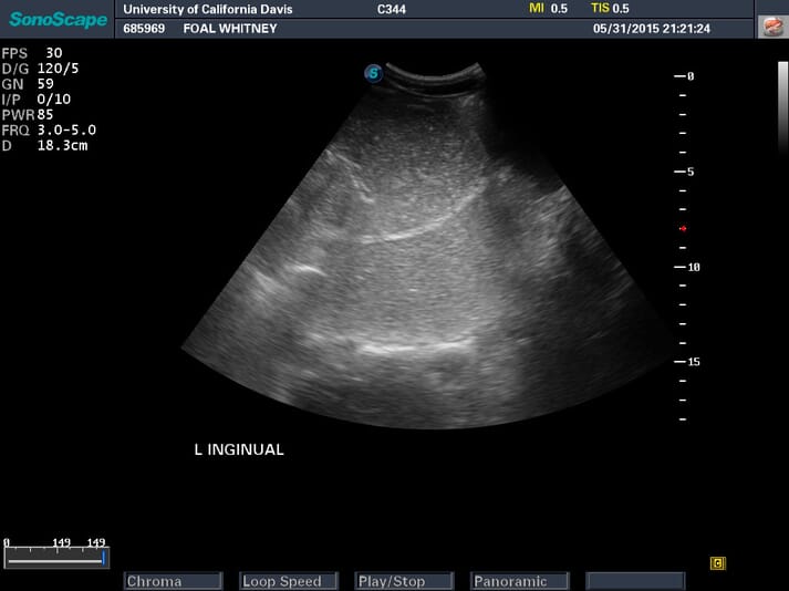 FIGURE 4 Evidence of large amounts of fluid in the colon on ultrasound