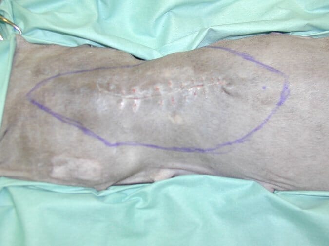 FIGURE 1 Wide margins should be marked for revision surgery
