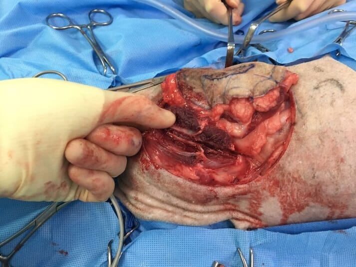 FIGURE 2 Partial scapulectomy is indicated when tumour lateral margin extends over the dorsal aspect of the scapula
