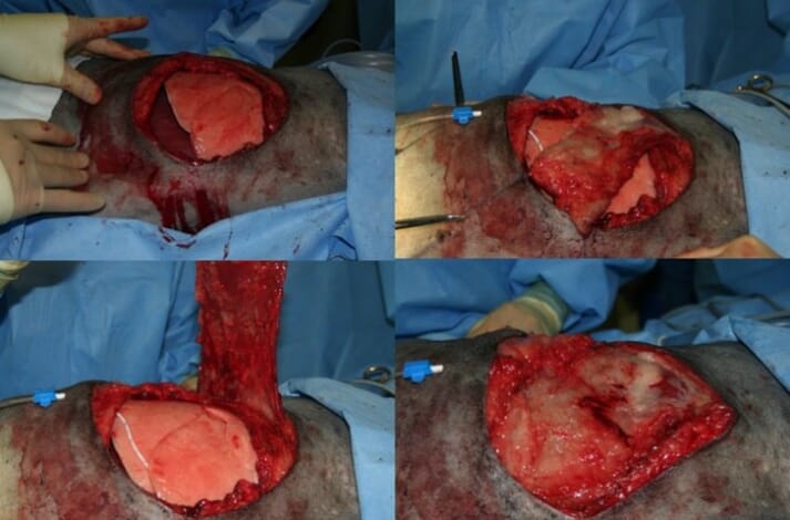 FIGURE 3 Thoracic wall resection can be closed via latissimus dorsi muscle flaps (shown here in a canine patient)