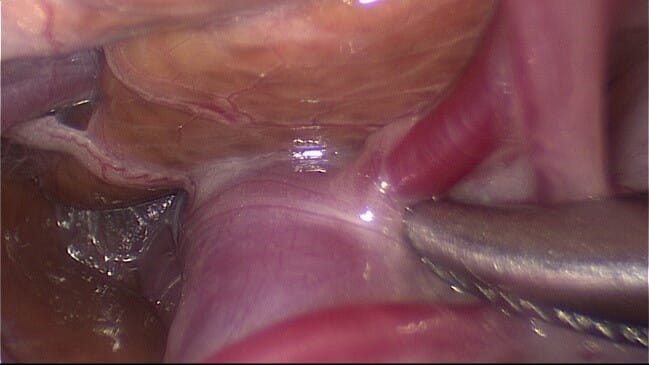 Laparoscopic surgery image