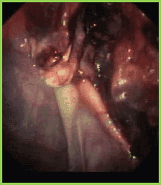 FIGURE (1) Endoscopic visualisation of a mycotic plaque over the roof of the guttural pouch and involving the internal carotid artery
