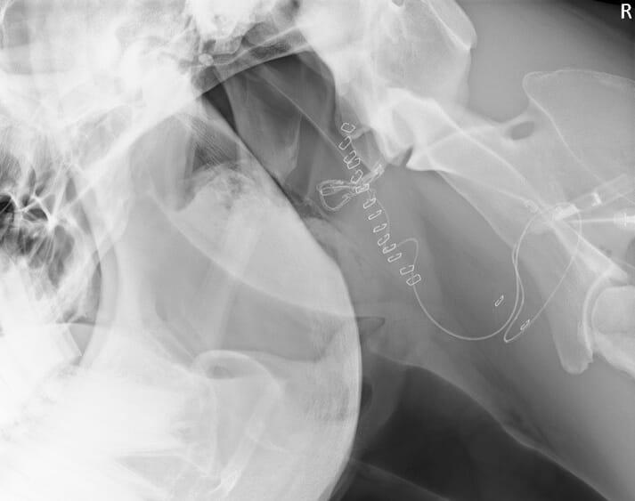 FIGURE (2) Radiographic view showing placement of a balloon catheter within the internal carotid artery: the balloon is inflated with contrast material for easier localisation