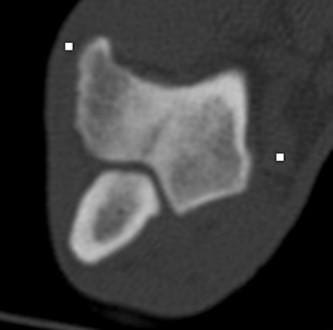 FIGURE (1) Sclerotic bone in the area adjacent to an intracondylar fissure can be seen in a CT image