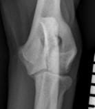 FIGURE (2) An intracondylar fissure is visible in a craniocaudal radiograph