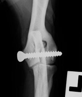 FIGURE (3) Large diameter transcondylar screws are placed to limit the risk of fatigue failure of the screw