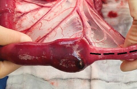 Intestinal foreign body