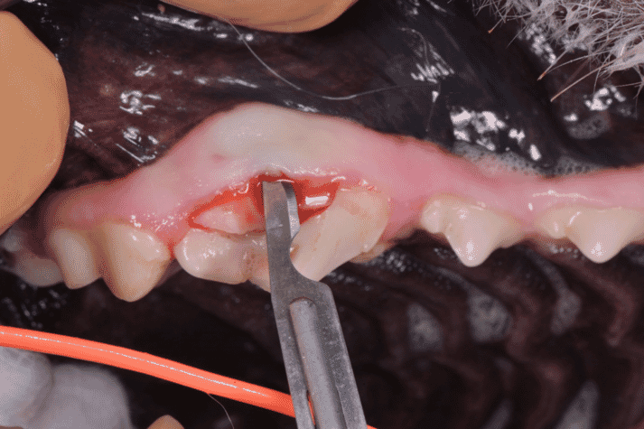 Tooth extraction
