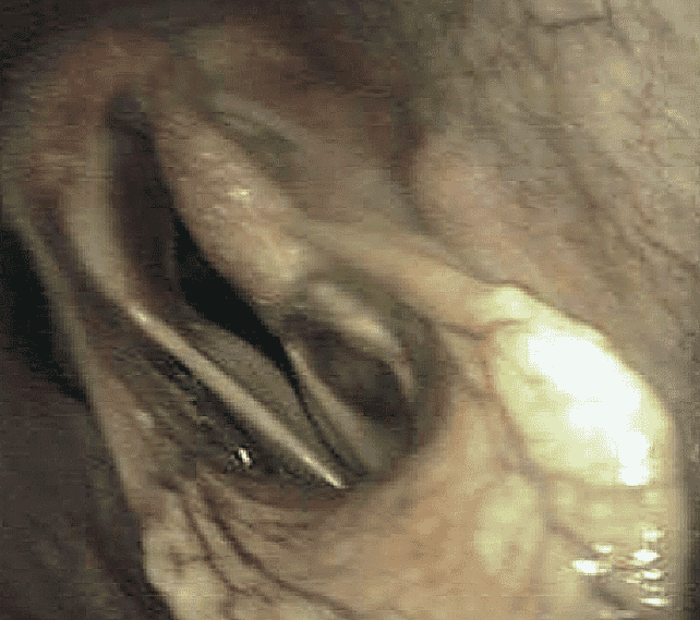FIGURE (1) This snapshot endoscopic image of the larynx during ridden exercise shows left-sided grade 4 (total paralysis) recurrent laryngeal neuropathy and marked bilateral vocal fold collapse