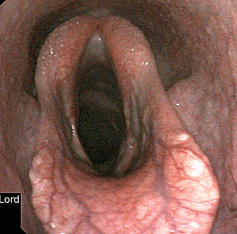 FIGURE (4) Five-month post-operative repeat endoscopic image of the larynx during ridden exercise showed very good abduction of both arytenoid cartilages