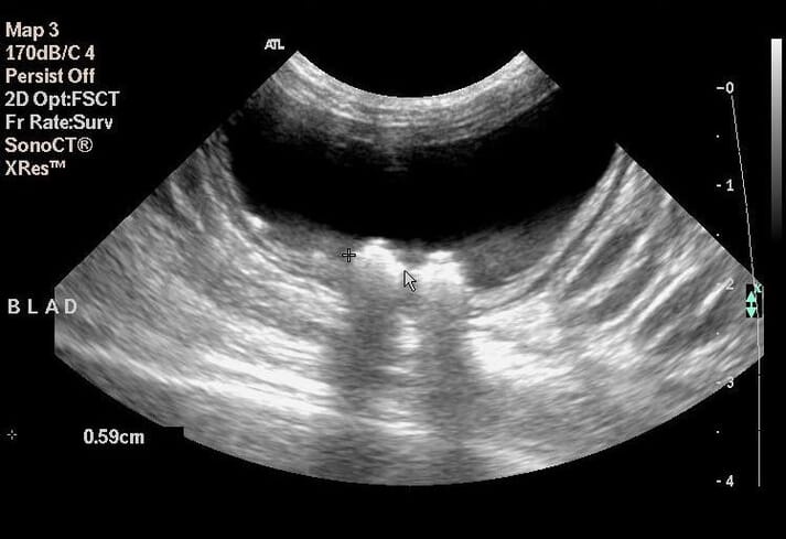 FIGURE (4) Ultrasound examination of a patient with pollakiuria and haematuria demonstrating two cystoliths causing acoustic shadowing