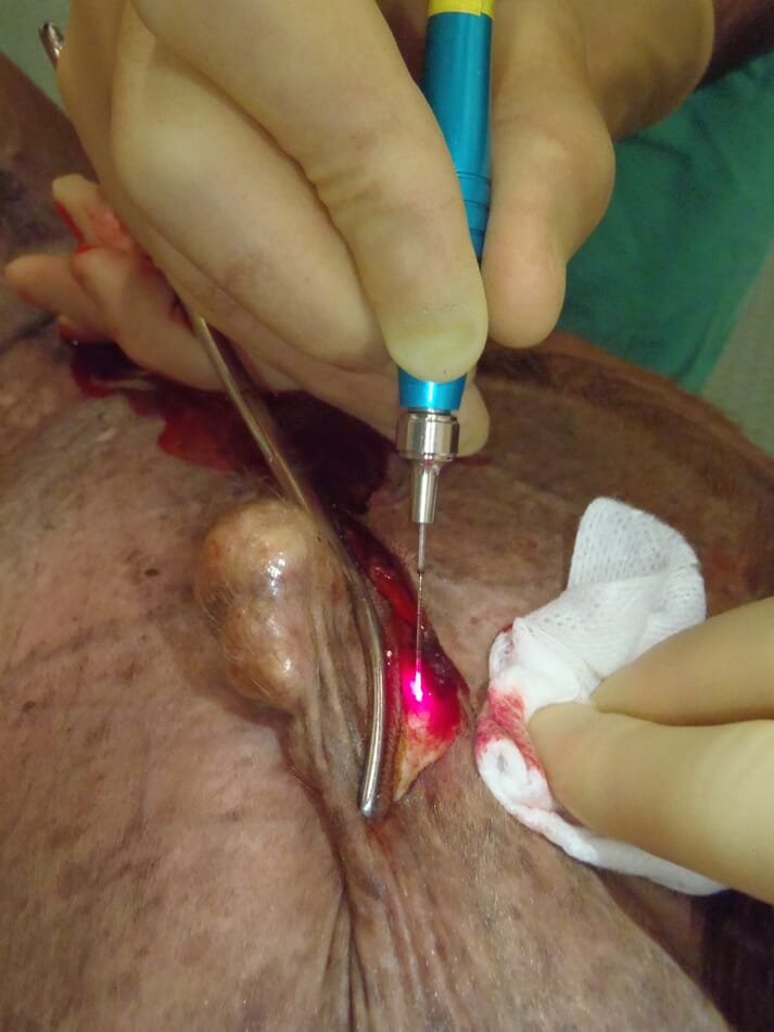FIGURE (3) Diode laser excision of a nodular sarcoid