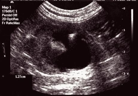 FIGURE 2 Ultrasound image of a right feline kidney with severe renal pelvic dilation (1.27cm)
