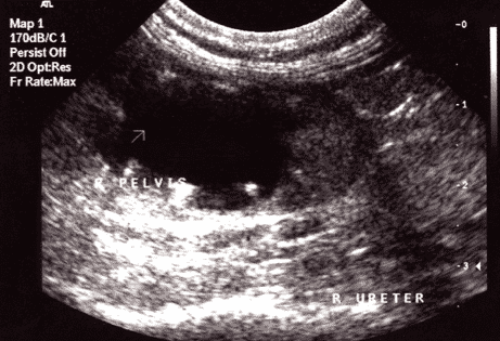 FIGURE 3 Ultrasound image of the same right feline kidney with evidence of dilated right ureter