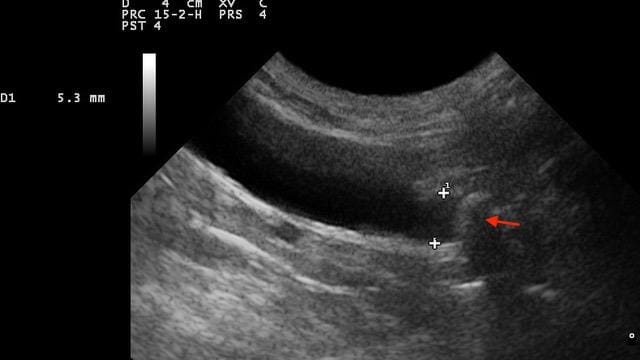 FIGURE 4 Ultrasound image of a severely dilated feline ureter (5.3mm) and shadowing caused by a ureterolith (red arrow) (image courtesy of Monica Merlo)