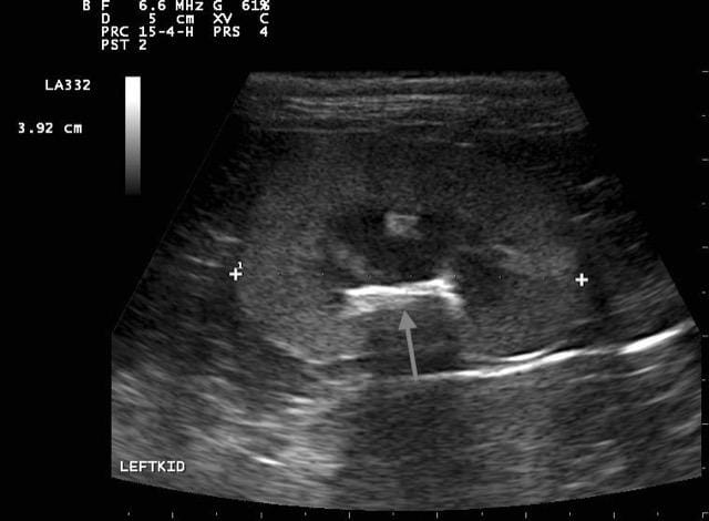 FIGURE 5 Ultrasound image of a feline kidney demonstrating renal pelvic mineralisation (grey arrow) (image courtesy of Monica Merlo)