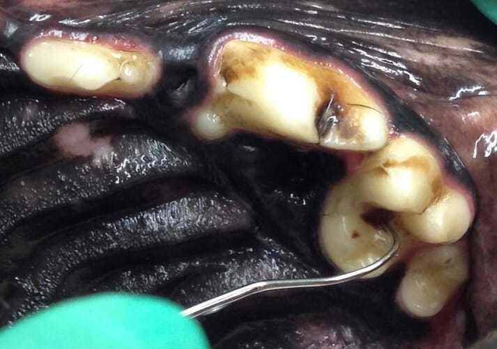 FIGURE (1) A dental explorer of the “Shepherd’s hook” type is used to diagnose a caries lesion in the occlusal pit of the left maxillary first molar tooth/209. Note also the plaque presence in the developmental groove of the left maxillary fourth premolar tooth/208; a caries lesion was diagnosed at this site as well.