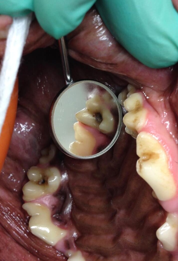 FIGURE (2) Diagnosis of bilateral caries in the maxillary first molar teeth in a dog; demonstration of the use of a dental mirror to facilitate the inspection of a tooth surface that is facing away from the operator. Both lesions were relatively early lesions and the teeth could be saved with restorations.