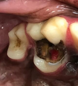 caries molar lesion lesions