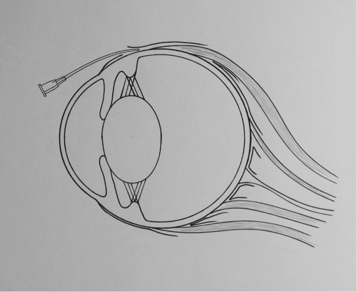 Inserting a sub-Tenon capsule block (image copyright Ace Vets Ltd)
