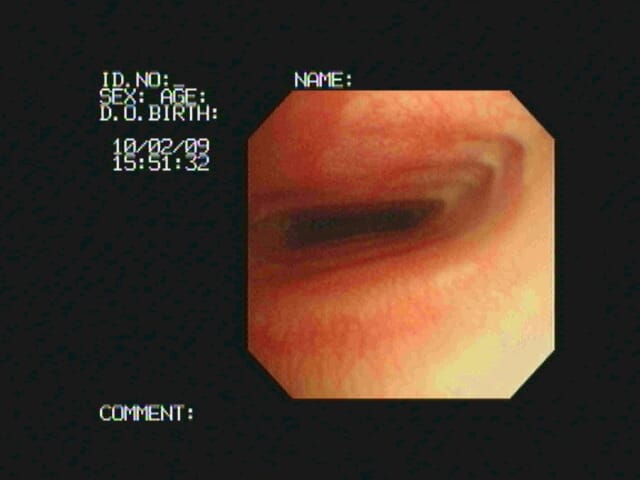 FIGURE 2 Tracheal collapse seen on tracheoscopy of a dog with a typical harsh cough worsened by excitement