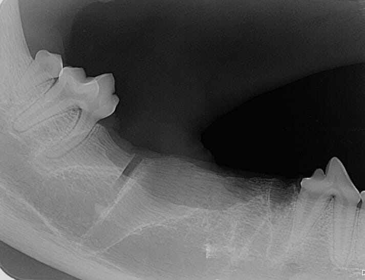 FIGURE 3 Complete removal of the teeth was confirmed with post-operative radiographs