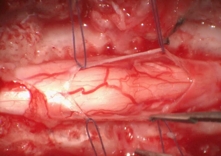 FIGURE 1 Microphotography of a durectomy performed in a pug after removal of a subarachnoid diverticulum under microscopic control. The holding sutures are of a 6-0 suture (0.07mm in diameter). Note the clarity of visualisation of delicate structures, such as spinal vessels and the spinal cord itself