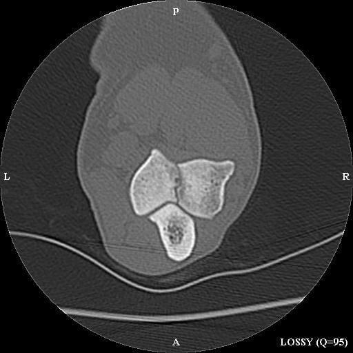 FIGURE (2) CT scans reveal a complete fissure