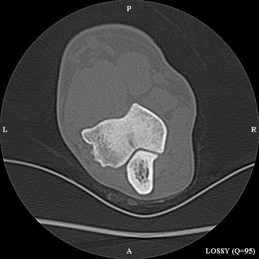 FIGURE (3) CT scans reveal a partial fissure with sclerosis on either side of the defect
