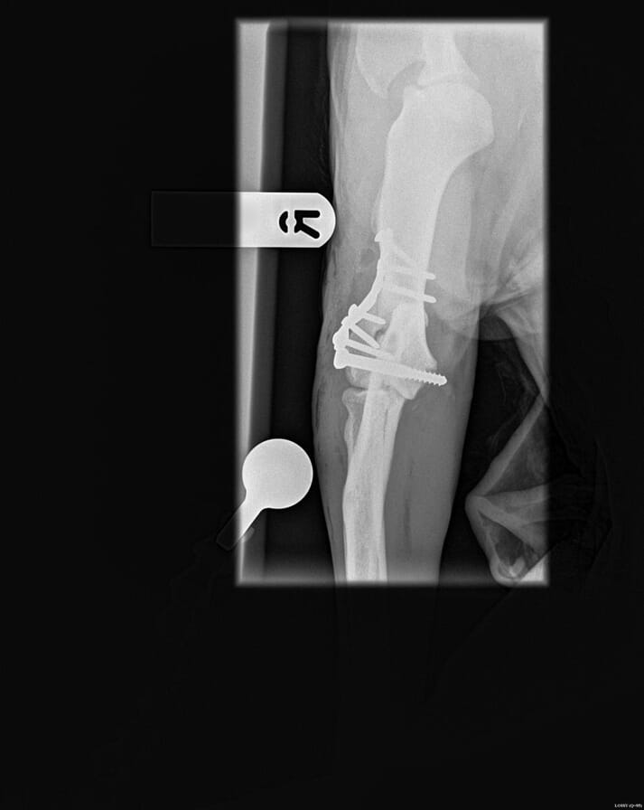 FIGURE (4) A lateral condylar fracture repair with a plate supporting the epicondylar ramus and a 4.5mm shaft screw across the condyles