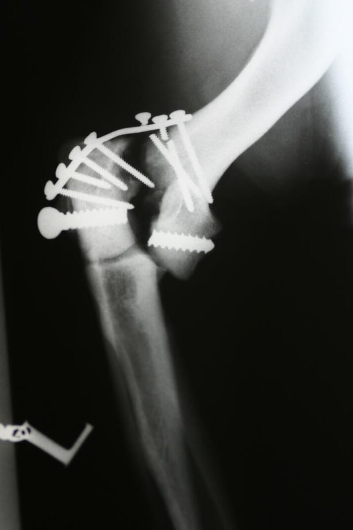 FIGURE (5) Fracture repair failure; broken screws with displacement necessitating a repair review