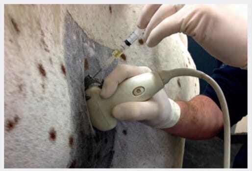 ▲ FIGURE 3 Arthrocentesis of the left C6/7 articular process joint prior to medication, performed under ultrasound guidance