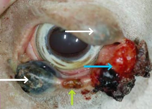 FIGURE (5) A highly complex mixture of tumours on the eyelids.
