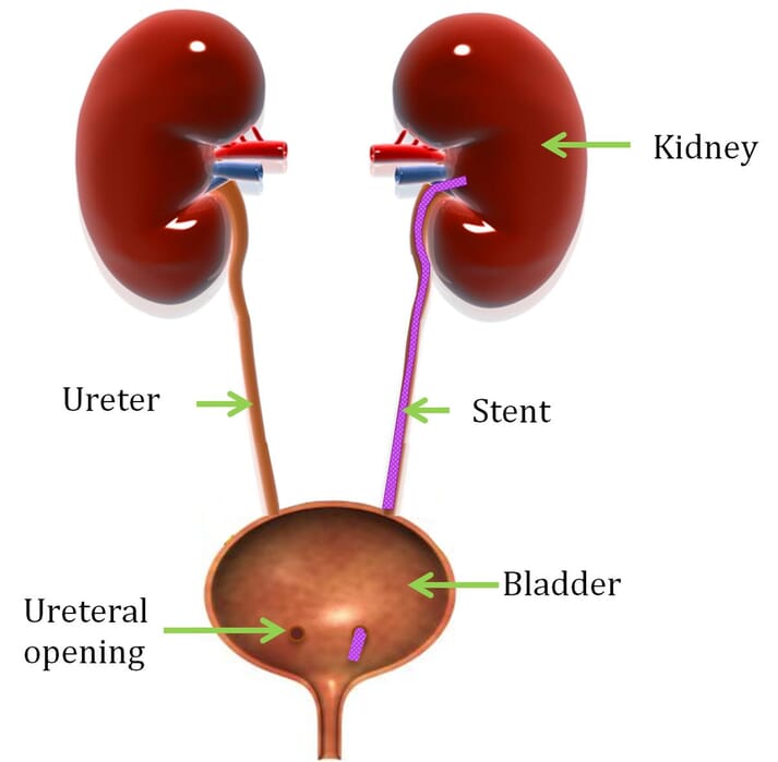 FIGURE 1 One end of the ureteral stent is secured in the renal pelvis and the other is secured at the ureteric opening into the bladder trigone