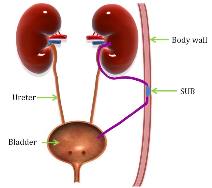 FIGURE 2 For SUB placement, a pigtail catheter is inserted into the renal pelvis and connected to a subcutaneous access port. A second catheter is also inserted into the bladder, which is also connected to the subcutaneous access port