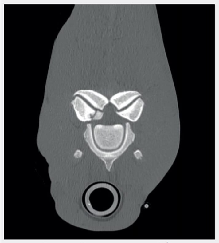 ▲ FIGURE 2 Transverse CT scan at the level of the C4/5 articular process joints, showing a large osteochondral fragment in the axial aspect of the left joint, which was not identified on initial radiography